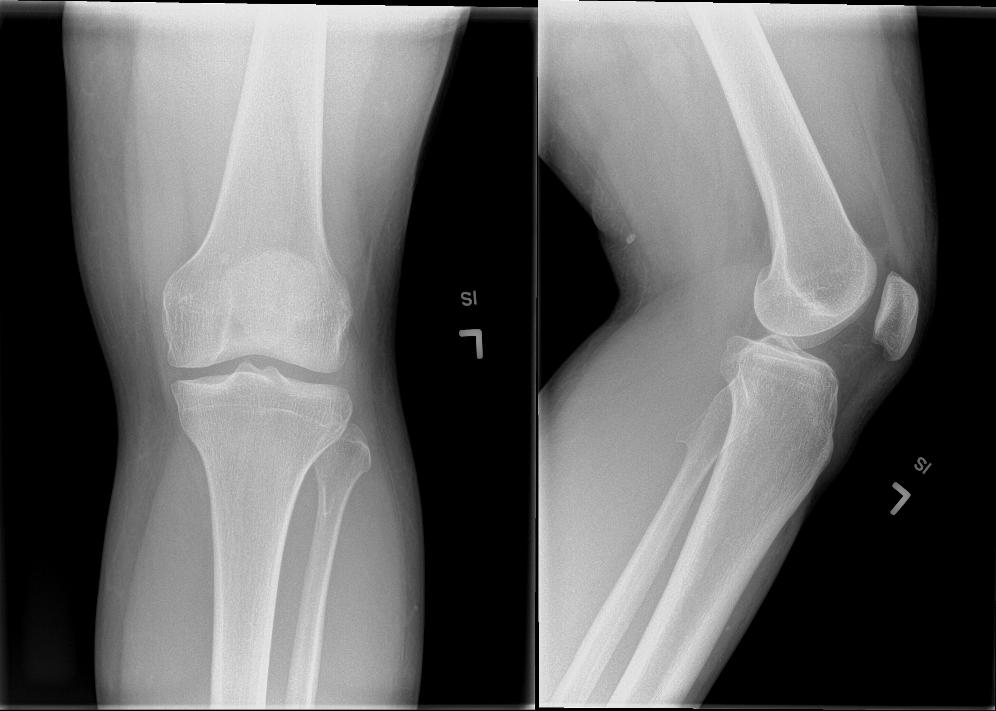 First misdiognosis at patella tendonitirs